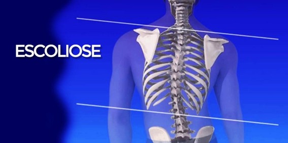 ESCOLIOSE